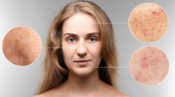 How Effective Are Antibiotics in Acne Treatment? Acne skin treatment. Photo via adobe