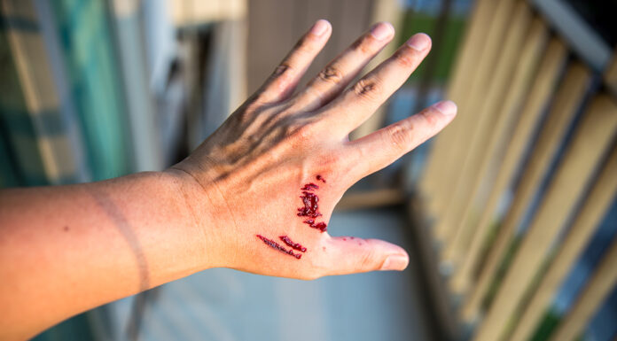 Did A Dog Bite You Recently? Here’s How To Handle It The Right Way Dog bite. Photo via adobe by Kanpisu