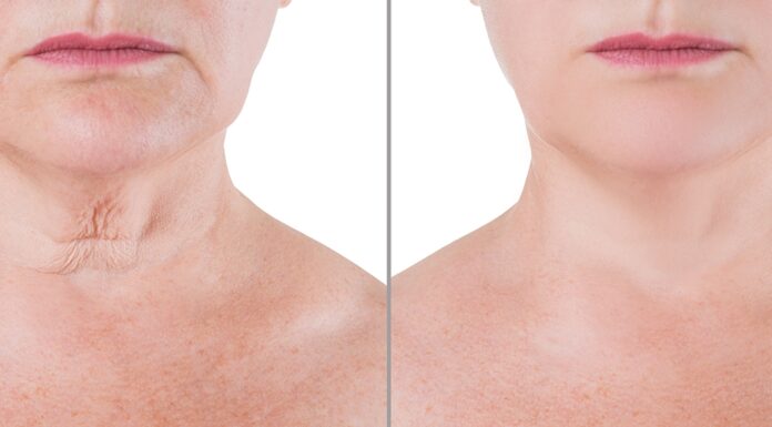 6 Reasons To Consider A 3D Facelift Procedure For Your Face 3D Facelift Procedure