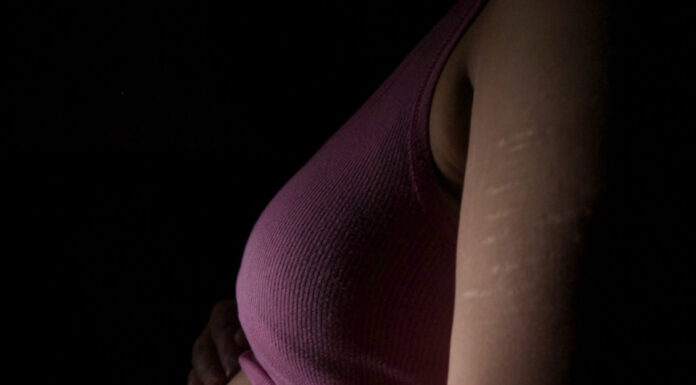 Can Kratom Help In Reducing Stretch Marks After Pregnancy? pregnancy scars and Kratom