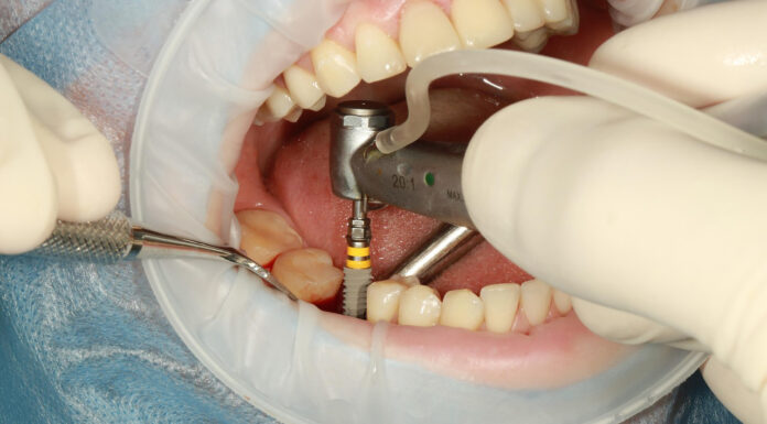 4 Common Questions About Dental Implants, Answered Dental Implants on a customer. Image by володимир волощак from Pixabay