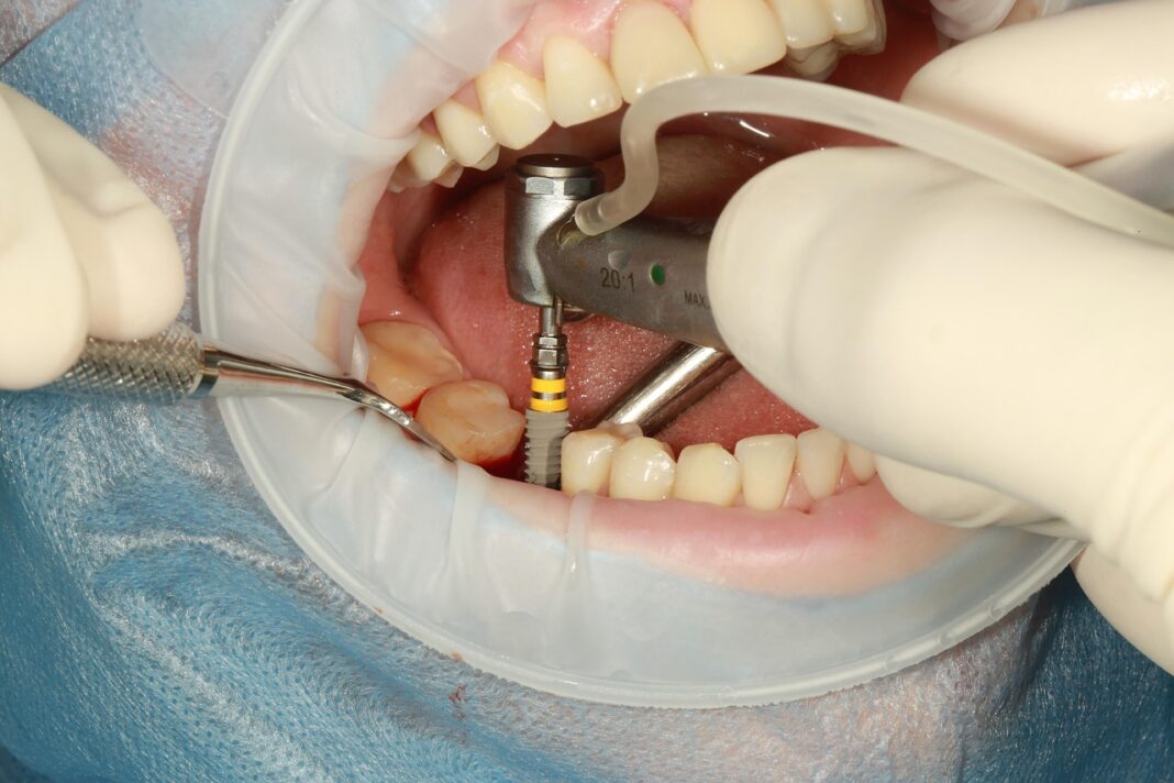 Missing Teeth career confidence is important. Photo by володимир волощак from Pixabay