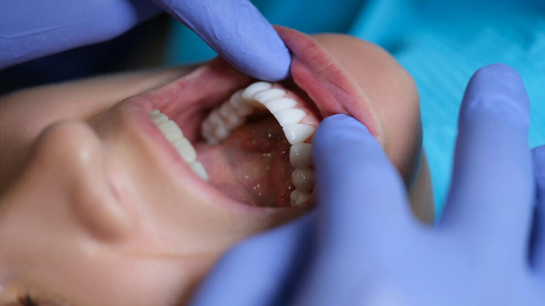 Smoking Impact Dental Implant. Photo by Getty Images via unsplash