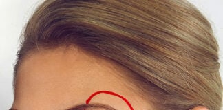Eyebrow Lift setup for surgery. Photo by Ayo Ogunseinde via unsplash
