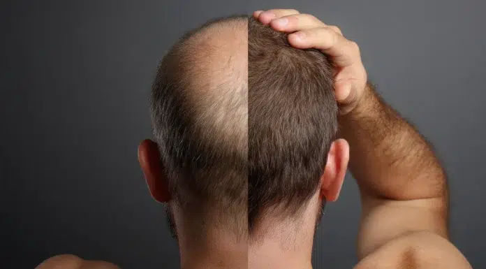 How Much Does an FUE Hair Transplant Cost? How Much Does an FUE Hair Transplant Cost. Vecteezy-medium