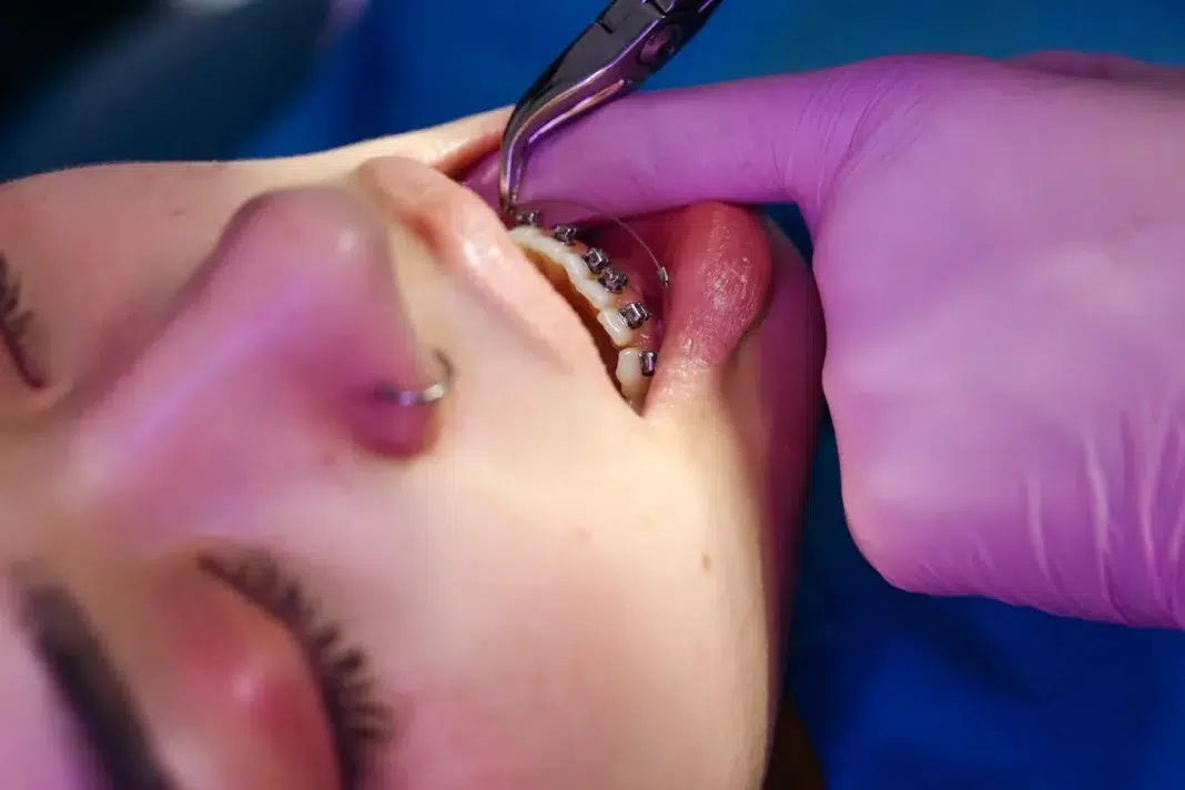 Proper teeth Alignment is essential for your smile. Photo via pexels by cottonbro
