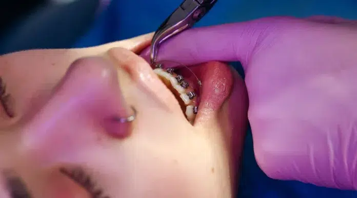 Why Proper Teeth Alignment Affects More Than Your Smile Proper teeth Alignment is essential for your smile. Photo via pexels by cottonbro