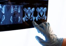 Understanding Hip Replacement Surgery and Its Purpose: A Guide for Patients in Singapore Hip replacement surgery. Vecteezy-medium