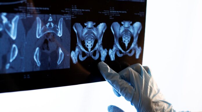 Understanding Hip Replacement Surgery and Its Purpose: A Guide for Patients in Singapore Hip replacement surgery. Vecteezy-medium