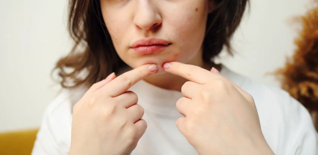 Skincare issues making acne worse. Photo via pexels by Polina Tankilevitch Skincare issues making acne worse. Photo via pexels by Polina Tankilevitch