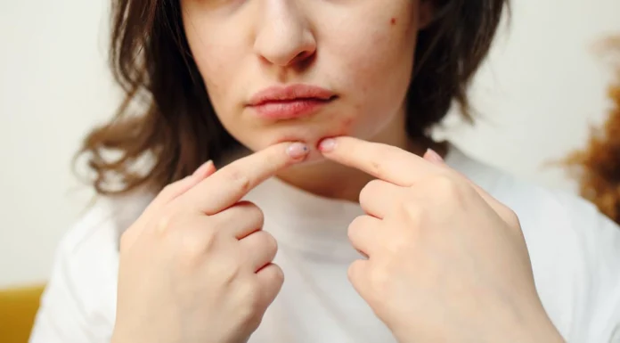 The Skincare Mistakes That Might Be Making Your Acne Worse Skincare issues making acne worse. Photo via pexels by Polina Tankilevitch