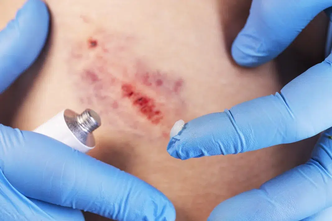 Scar Care After Dog Bite Healing. Vecteezy-medium Scar Care After Dog Bite Healing. Vecteezy-medium
