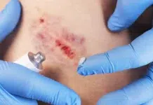 Scar Care After Dog Bite Healing When Results Differ From Expectations Scar Care After Dog Bite Healing. Vecteezy-medium