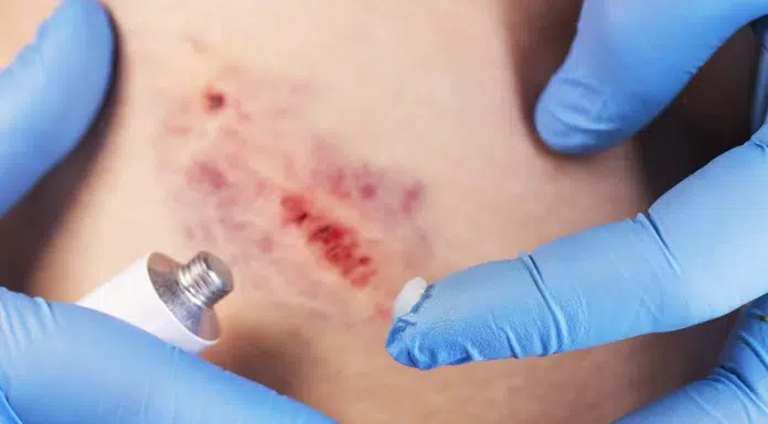 Scar Care After Dog Bite Healing When Results Differ From Expectations Scar Care After Dog Bite Healing. Vecteezy-medium