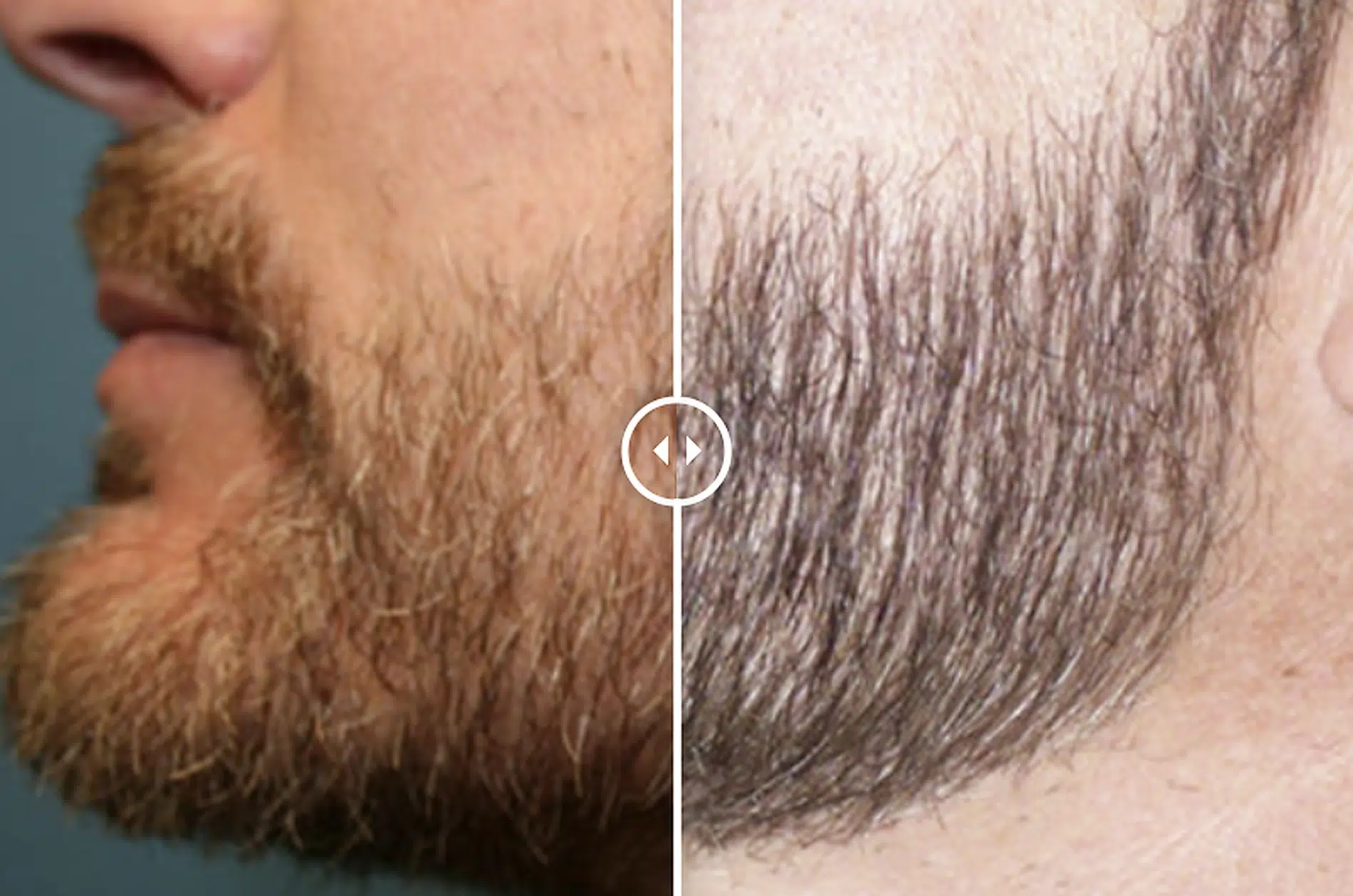 Beard Restoration Comparison Beard Restoration Comparison